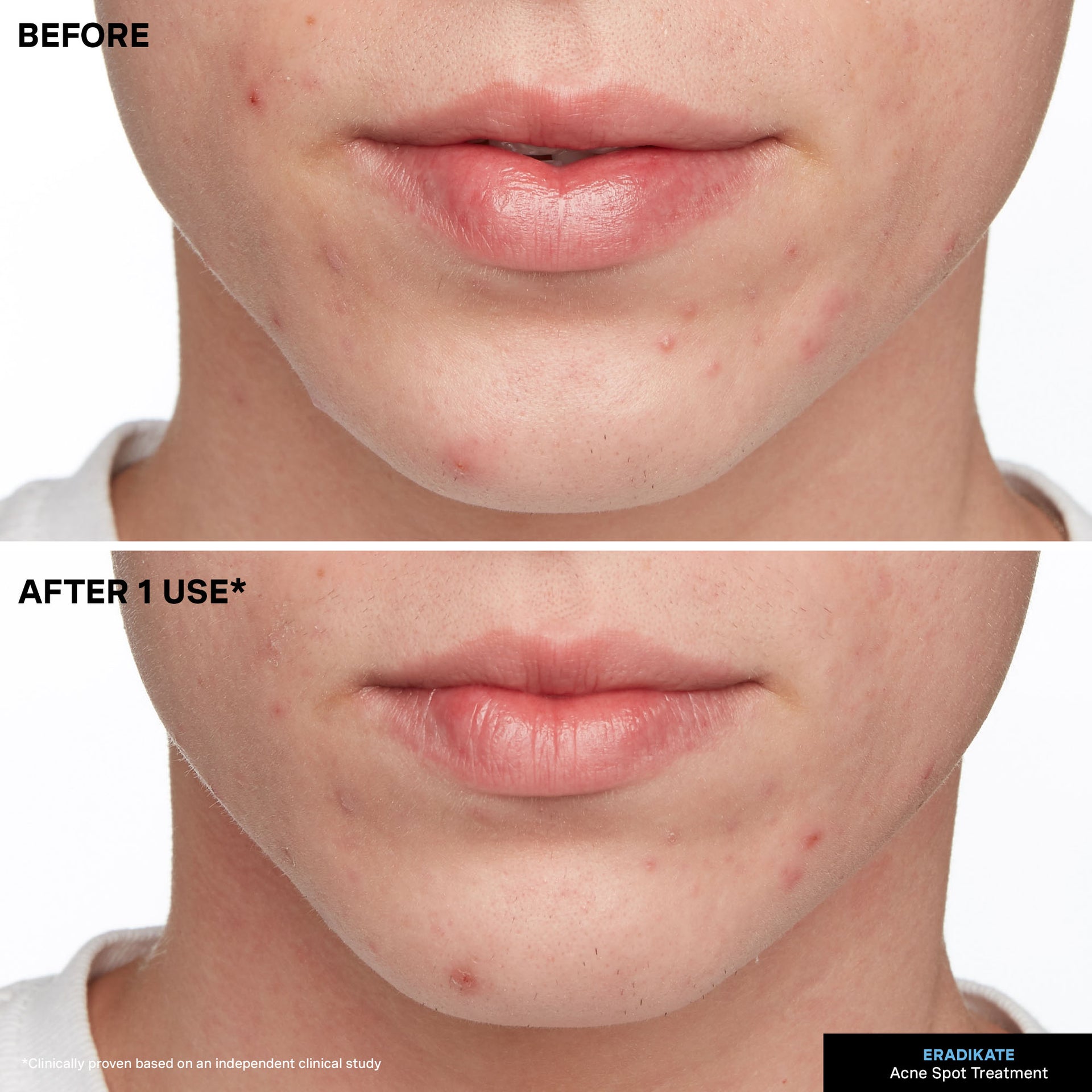 EradiKate® 10% Sulfur Blemish Treatment