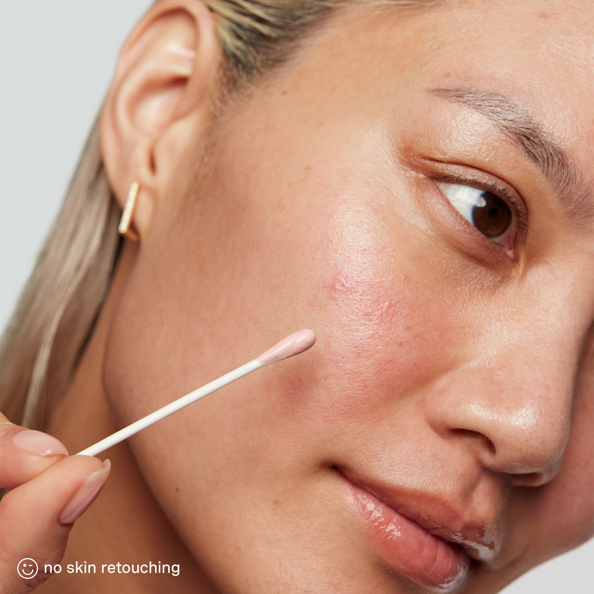 EradiKate® 10% Sulfur Blemish Treatment